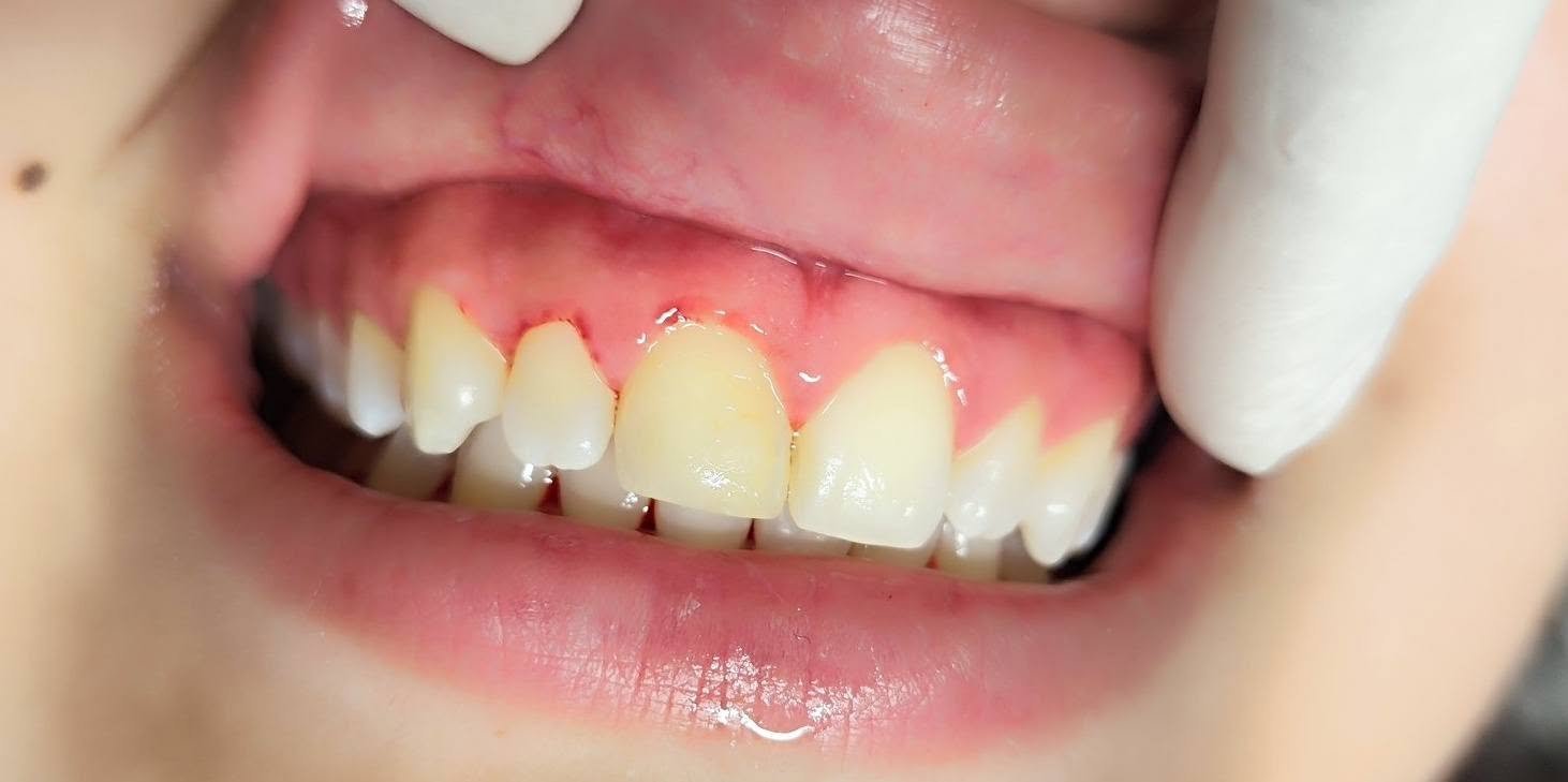 Composite veneers — Before