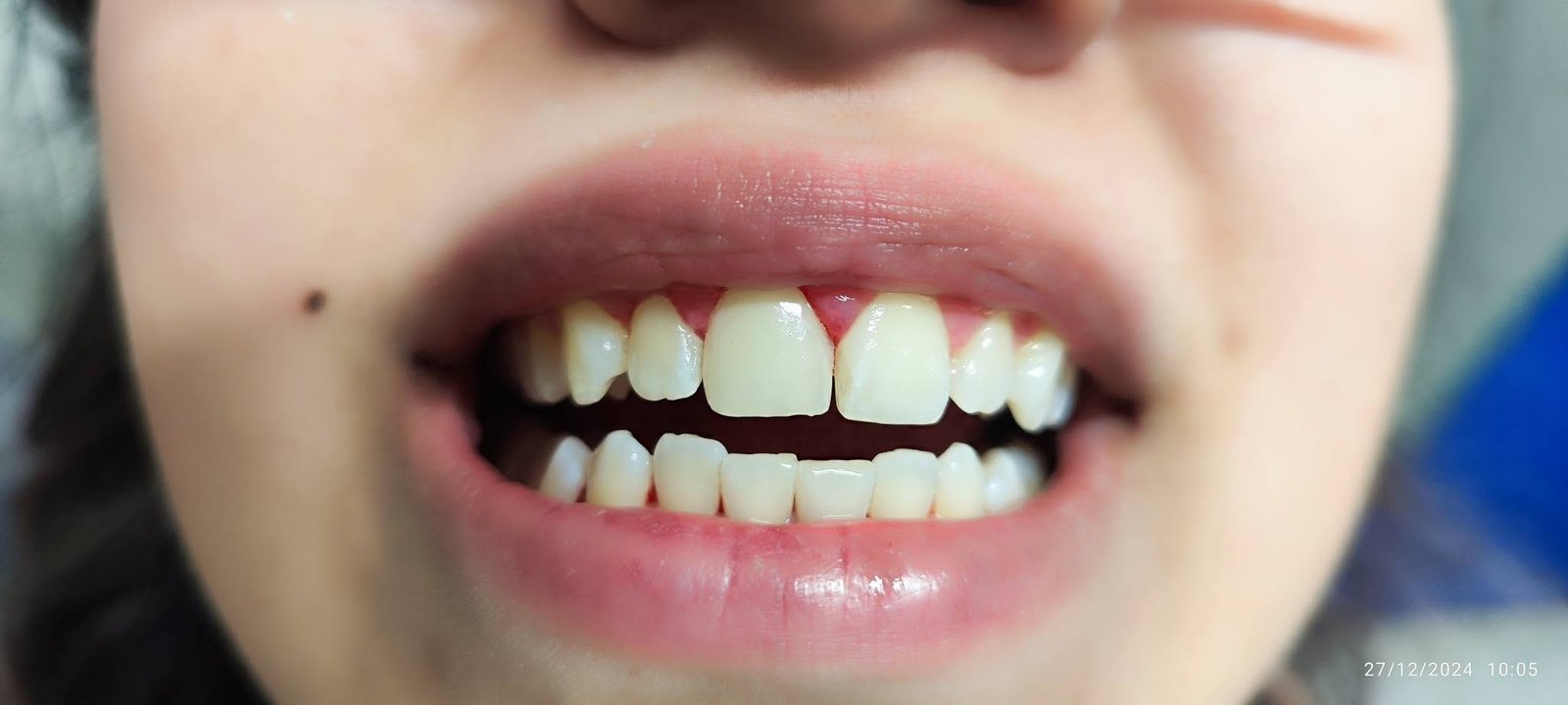 Composite veneers — After