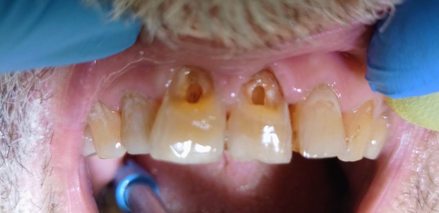 Front teeth reconstruction — Before