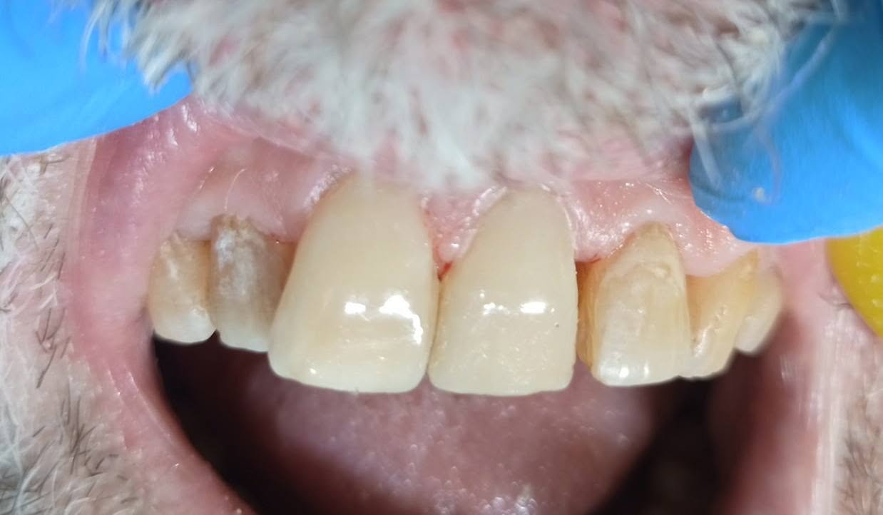 Front teeth reconstruction — After