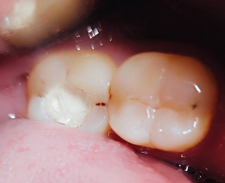Molar restoration — Before