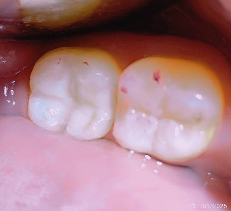 Molar restoration — After
