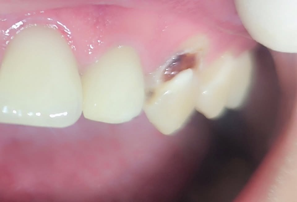 Cosmetic filling — Before