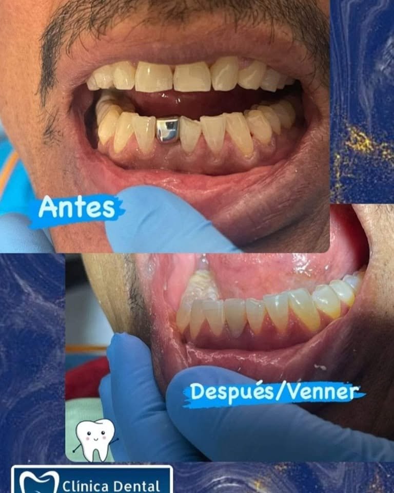 Veneers — Piedras Negras Dental Clinic