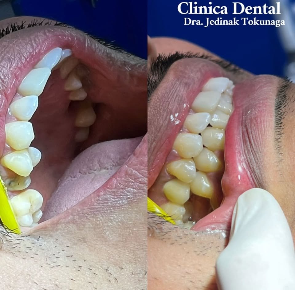 Coronas dentales — Clínica Dental Piedras Negras