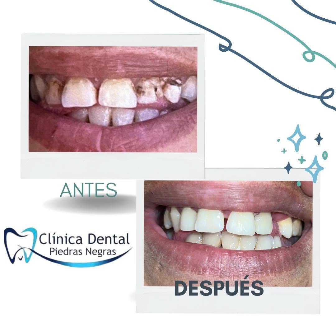 Prosthodontics — Piedras Negras Dental Clinic