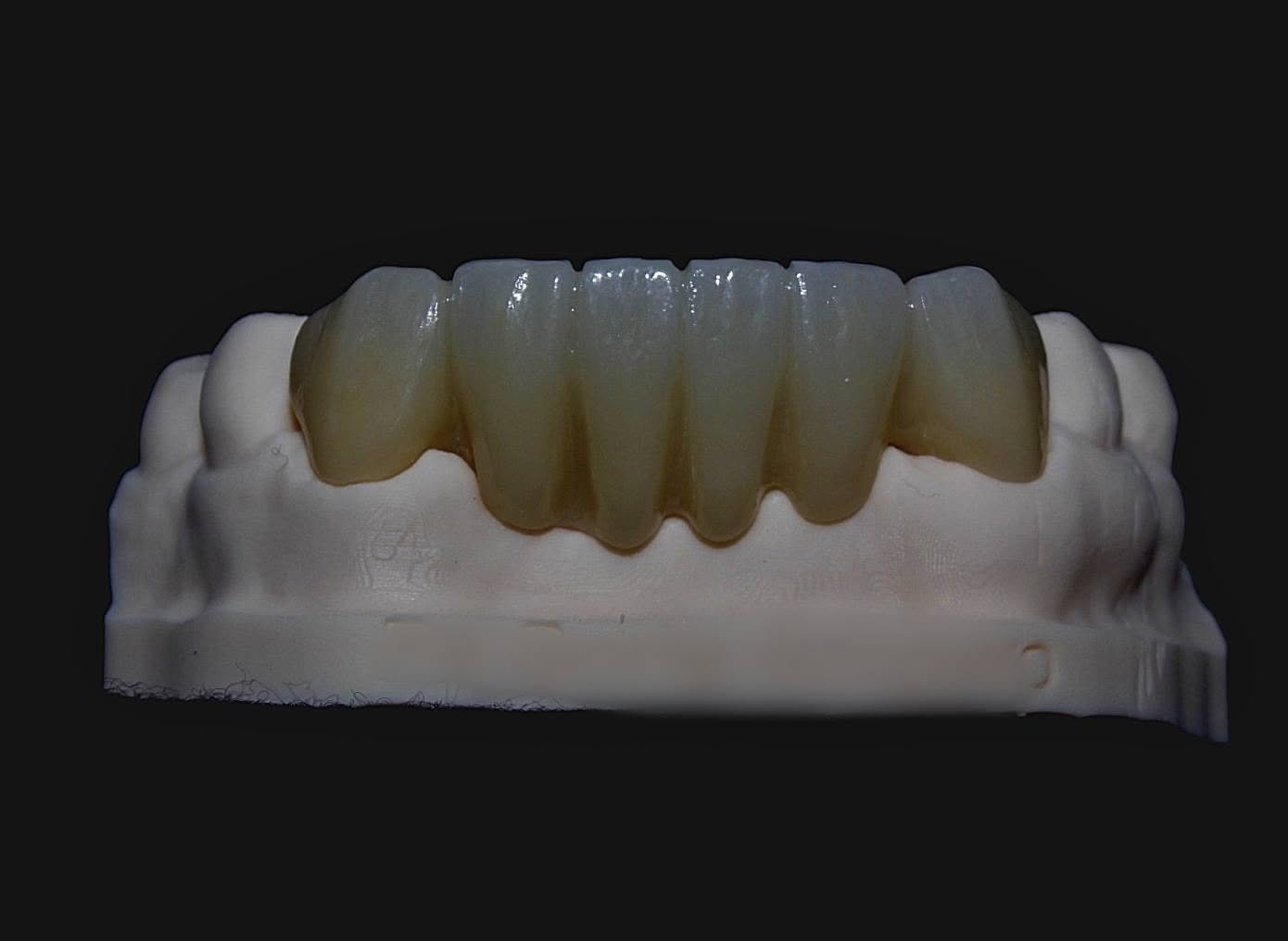 Puentes fijos y removibles — Clínica Dental Piedras Negras