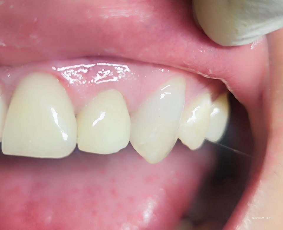 Resinas dentales — Clínica Dental Piedras Negras